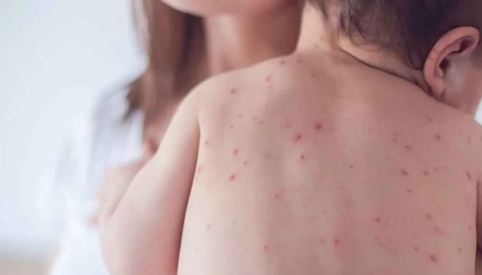 রাজশাহীতে হামের উপসর্গে আরও তিন শিশুর মৃত্যু