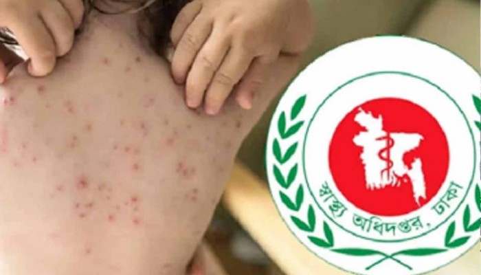 হাম ও হামের উপসর্গে আরও ৫ শিশুর মৃত্যু